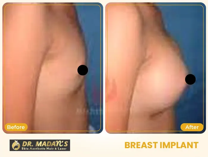 Breast implant before and after result 3 at Dr Madan Aesthetics